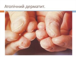 Атопический дерматит, грибок кожи рук и ногтей, что это?