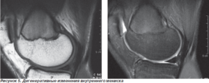 Дегенеративные изменения крестообразной связки