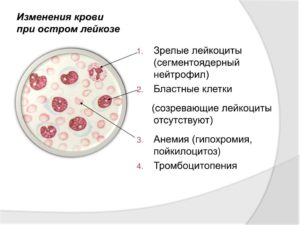 Острый лейкоз, тромбоцитопения