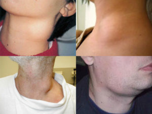 Увеличены лимфоузлы на шее, жжение в шее и груди