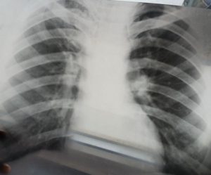 Расшифровка рентгена легких онлайн