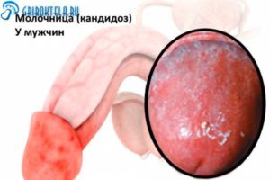 Частичное изменение цвета головки полового члена