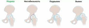 Дисплазия тбс у ребенка, утиная походка