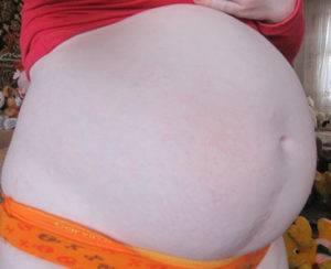 Беременность после кесарева через 9 месяцев