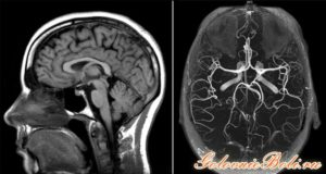 Расшифровка МРТ-снимка головного мозга