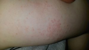 Аллергическая сыпь после антибиотика