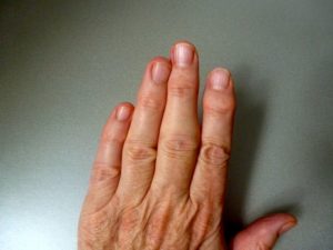 Воспаление фаланги безымянного пальца