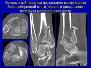 Перелом дистального отдела большеберцовой кости закрытый перелом (снимки)