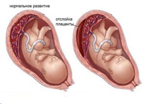 Отслойка плаценты на 7 неделе беременности