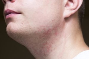 Раздражение кожи на шее и груди после бритья