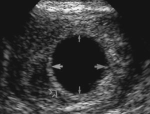 Беременность. Нечеткие неровные контуры эмбриона