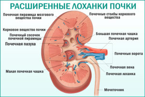 Пиелоэктазия правой почки у беременной