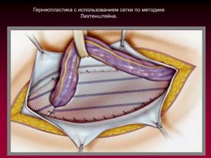 Послеоперационный период после лечения паховой грыжи по Лихтенштейну