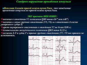 Замедление проведения хода возбуждения по правой ножке пучка Гиса