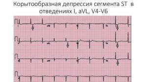 Депрессия сегмента st (2,3, avf). v4-v6