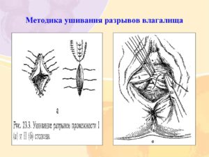 Разрыв влагалища