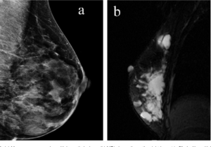 Недифференцированный рак молочной железы