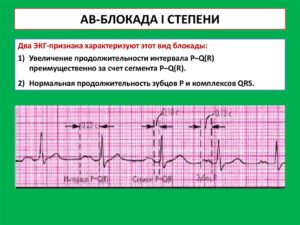 АВ блокады 2 ст. Тип 1 у ребенка, занимается спортом