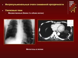 Что такое множественные мелкие очаги в паренхиме обоих легких