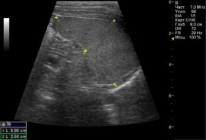 Увеличенная селезенка по УЗИ