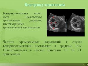 Что такое вентрикулодилятация?