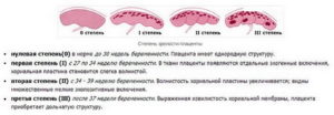32 неделя беременности толщина плаценты 0 степени