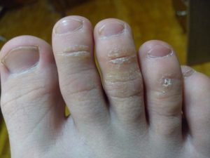 Зуд под ногтем на пальце ноги