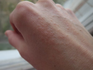 Сыпь на кистях рук