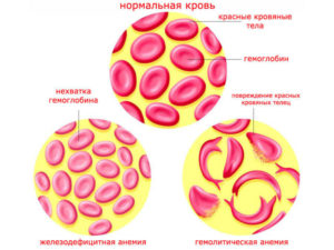 Гемолитическая анемия