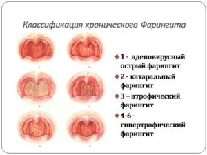 Оак на фоне хронического фарингита