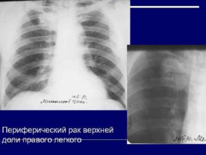 Единичное мелкое солитарное образование нижней доли левого лёгкого