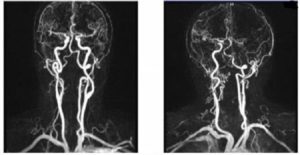Патологическая извитость левой позвоночной артерии Потеря слуха!