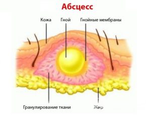 Незаживающая полость после вскрытия абсцесса