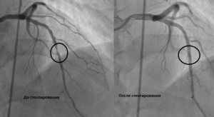 Результат коронарографии стентирование или АКШ