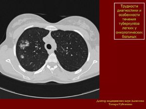 Расшифровка КТ после туберкулёза