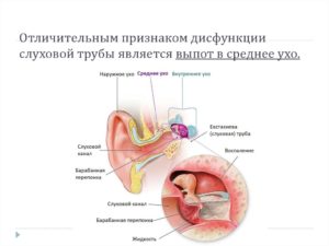 Двусторонняя дисфункция слуховых труб