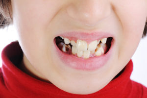 Плохие молочные зубы у ребенка