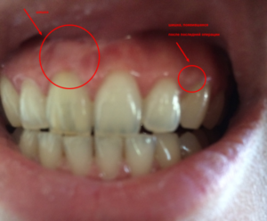 Белое пятно на десне после удаления зуба