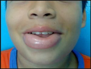 Отекла верхняя губа после лечения зубика