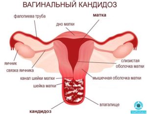 Жжение во влагалище и боли в яичниках