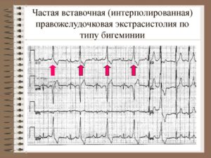 Частая желудочковая экстрасистолия по типу бигеминии