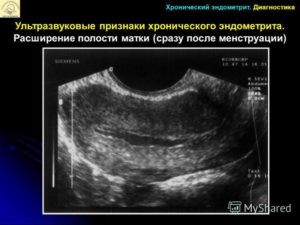 Хронический эндометрит после замершей беременности