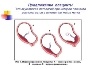 Краевое предлежание плаценты