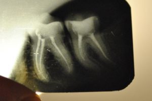 Депульпипованный зуб реагирует на горячее