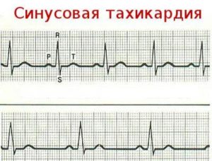 Синусовая тахикардия, высокое давление