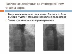 Дилатация восходящей аорты у ребенка