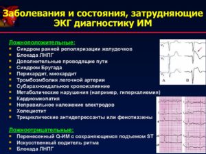 ЭКГ может ли не обнаружить заболевания сердца?