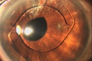 Хрусталик миол-2 при катаракте