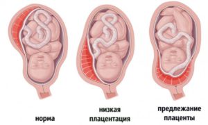 Беременность 19 недель плацентация