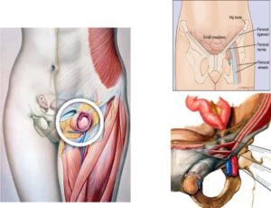 Боль между пахом и ногой